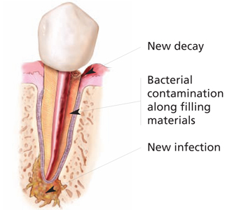 Root Canal Retreatment