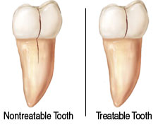 What Can I Do To Prevent My Teeth From Cracking?