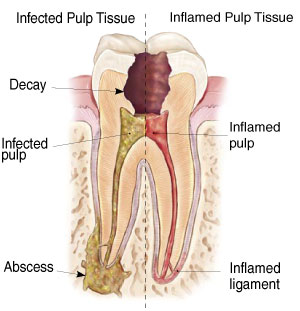 Infected Tissue - Root Canal